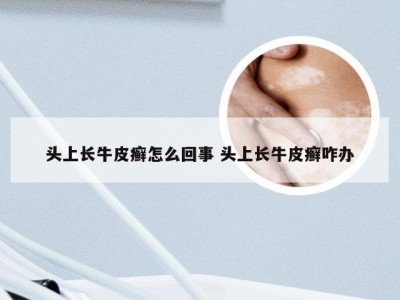 头上长牛皮癣怎么回事 头上长牛皮癣咋办