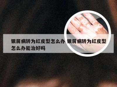 银屑病转为红皮型怎么办 银屑病转为红皮型怎么办能治好吗