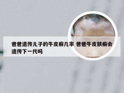 爸爸遗传儿子的牛皮癣几率 爸爸牛皮肤癣会遗传下一代吗
