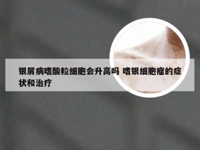 银屑病嗜酸粒细胞会升高吗 嗜银细胞瘤的症状和治疗