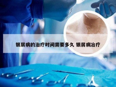 银屑病的治疗时间需要多久 银屑病冶疗