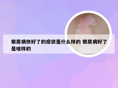 银屑病快好了的症状是什么样的 银屑病好了是啥样的