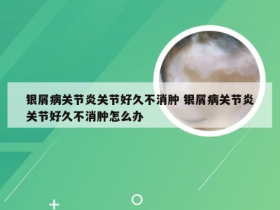 银屑病关节炎关节好久不消肿 银屑病关节炎关节好久不消肿怎么办