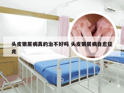 头皮银屑病真的治不好吗 头皮银屑病自愈征兆