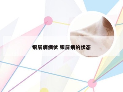 银屑病病状 银屑病的状态