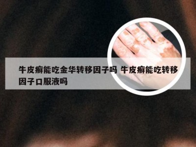 牛皮癣能吃金华转移因子吗 牛皮癣能吃转移因子口服液吗