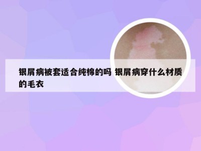 银屑病被套适合纯棉的吗 银屑病穿什么材质的毛衣