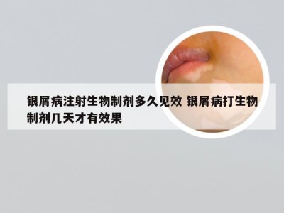 银屑病注射生物制剂多久见效 银屑病打生物制剂几天才有效果