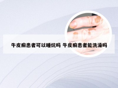牛皮癣患者可以睡炕吗 牛皮癣患者能洗澡吗