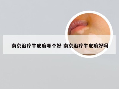 南京治疗牛皮癣哪个好 南京治疗牛皮癣好吗
