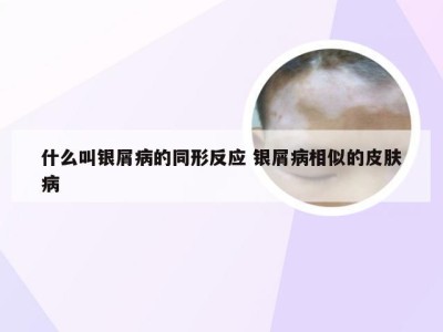 什么叫银屑病的同形反应 银屑病相似的皮肤病