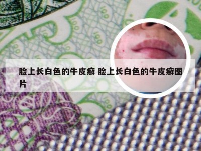 脸上长白色的牛皮癣 脸上长白色的牛皮癣图片