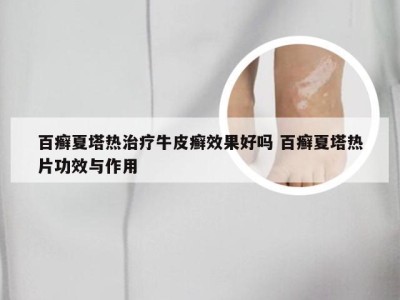 百癣夏塔热治疗牛皮癣效果好吗 百癣夏塔热片功效与作用