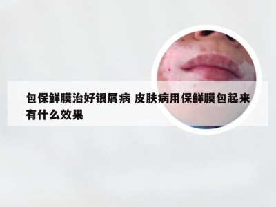 包保鲜膜治好银屑病 皮肤病用保鲜膜包起来有什么效果