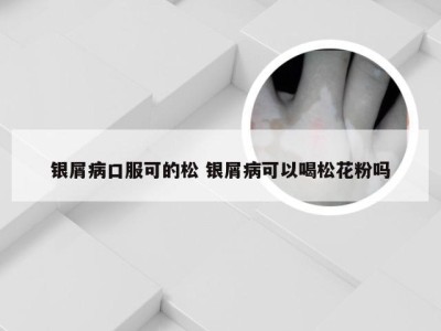银屑病口服可的松 银屑病可以喝松花粉吗