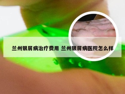 兰州银屑病治疗费用 兰州银屑病医院怎么样