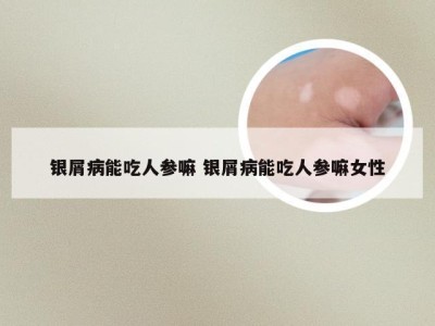 银屑病能吃人参嘛 银屑病能吃人参嘛女性
