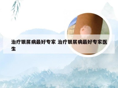 治疗银屑病最好专家 治疗银屑病最好专家医生