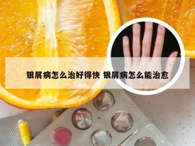 银屑病怎么治好得快 银屑病怎么能治愈