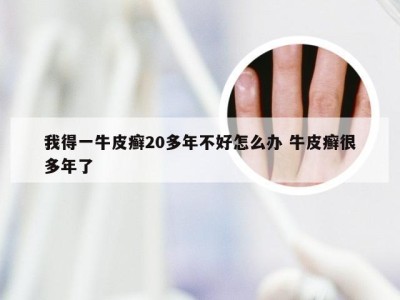 我得一牛皮癣20多年不好怎么办 牛皮癣很多年了