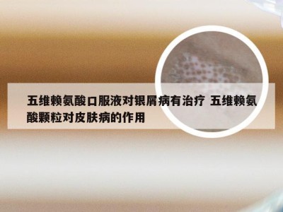 五维赖氨酸口服液对银屑病有治疗 五维赖氨酸颗粒对皮肤病的作用
