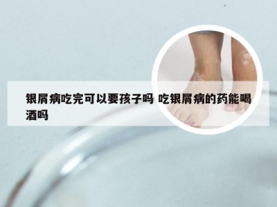 银屑病吃完可以要孩子吗 吃银屑病的药能喝酒吗