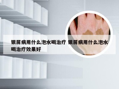 银屑病用什么泡水喝治疗 银屑病用什么泡水喝治疗效果好