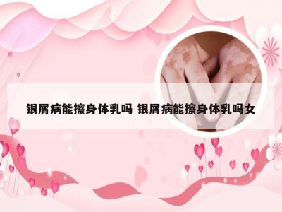 银屑病能擦身体乳吗 银屑病能擦身体乳吗女