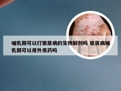 哺乳期可以打银屑病的生物制剂吗 银屑病哺乳期可以用外用药吗