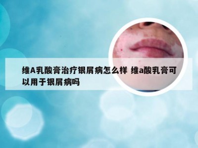 维A乳酸膏治疗银屑病怎么样 维a酸乳膏可以用于银屑病吗