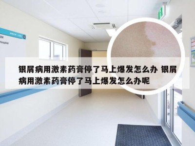 银屑病用激素药膏停了马上爆发怎么办 银屑病用激素药膏停了马上爆发怎么办呢