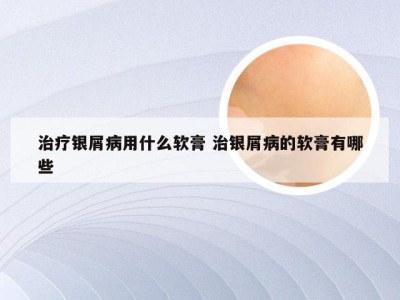 治疗银屑病用什么软膏 治银屑病的软膏有哪些