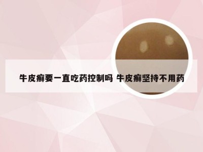 牛皮癣要一直吃药控制吗 牛皮癣坚持不用药