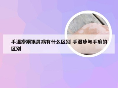 手湿疹跟银屑病有什么区别 手湿疹与手癣的区别