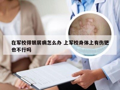 在军校得银屑病怎么办 上军校身体上有伤钯也不行吗