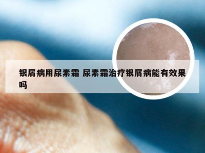 银屑病用尿素霜 尿素霜治疗银屑病能有效果吗