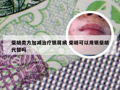 柴胡类方加减治疗银屑病 柴胡可以用银柴胡代替吗