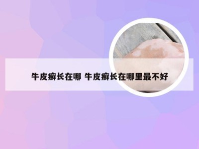牛皮癣长在哪 牛皮癣长在哪里最不好