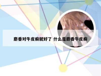 麝香对牛皮癣就好了 什么是麝香牛皮癣