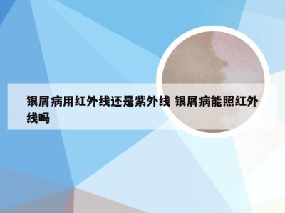 银屑病用红外线还是紫外线 银屑病能照红外线吗