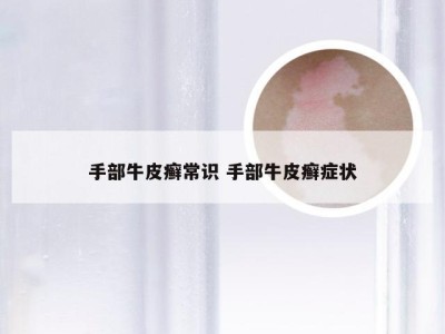 手部牛皮癣常识 手部牛皮癣症状