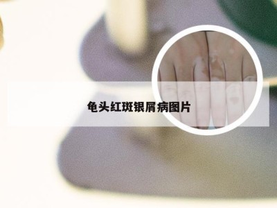 龟头红斑银屑病图片