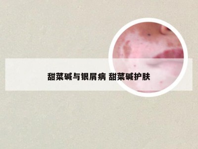 甜菜碱与银屑病 甜菜碱护肤