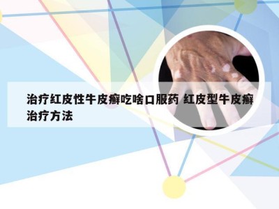 治疗红皮性牛皮癣吃啥口服药 红皮型牛皮癣治疗方法