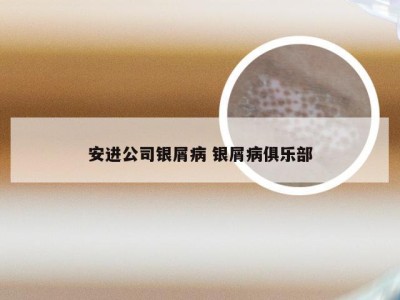 安进公司银屑病 银屑病俱乐部
