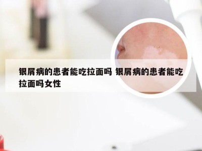 银屑病的患者能吃拉面吗 银屑病的患者能吃拉面吗女性