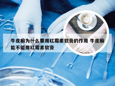牛皮癣为什么要用红霉素软膏的作用 牛皮癣能不能用红霉素软膏