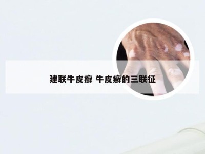 建联牛皮癣 牛皮癣的三联征