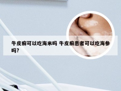 牛皮癣可以吃海米吗 牛皮癣患者可以吃海参吗?