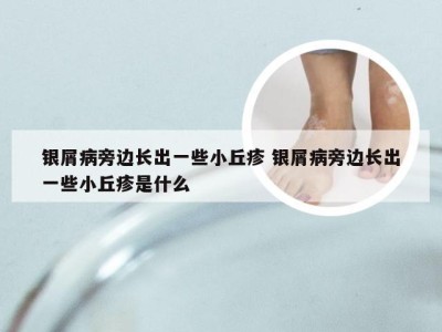 银屑病旁边长出一些小丘疹 银屑病旁边长出一些小丘疹是什么